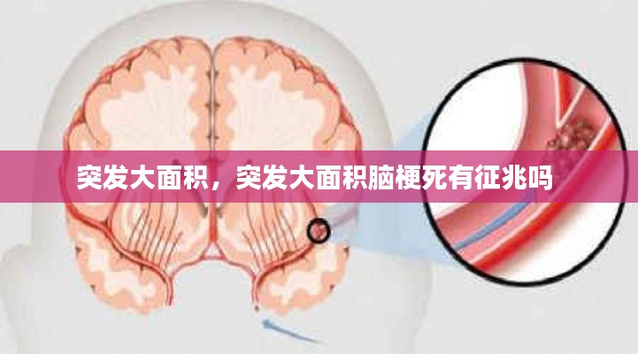 突发大面积，突发大面积脑梗死有征兆吗 