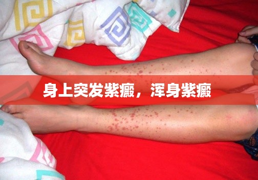 身上突发紫癜，浑身紫癜 