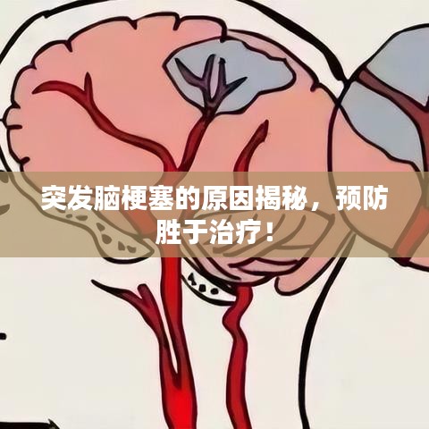 突发脑梗塞的原因揭秘，预防胜于治疗！