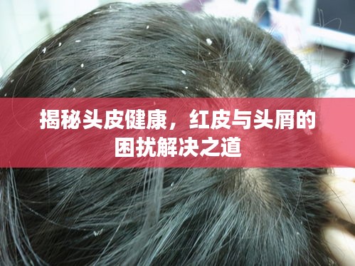 揭秘头皮健康，红皮与头屑的困扰解决之道