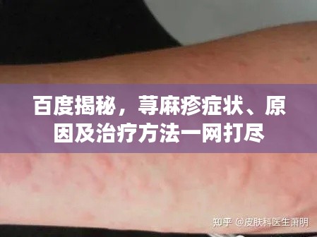 百度揭秘，荨麻疹症状、原因及治疗方法一网打尽